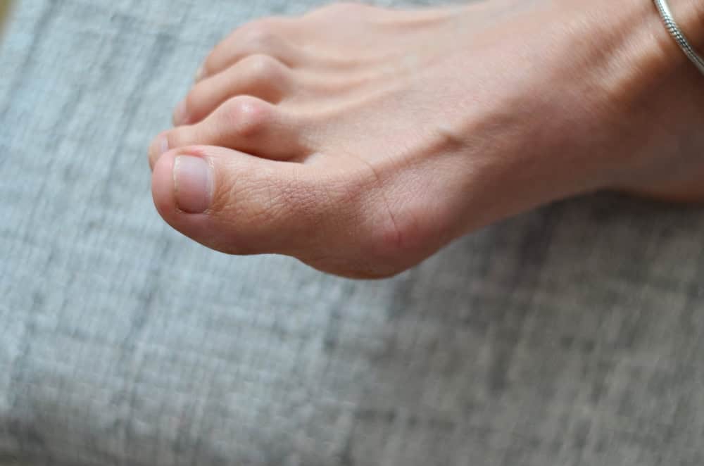 woman foot with hammertoes